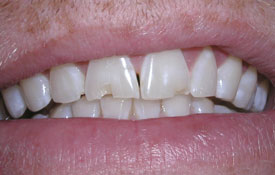 Patient with chipped front tooth