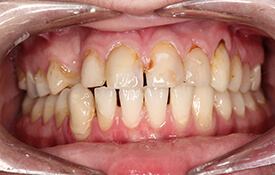 Smile with discoloration at gums