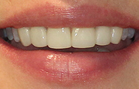 Closeup of picture-perfect front teeth