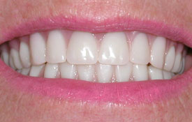 Smile with front tooth gap closed