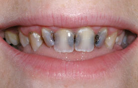 Severely decayed front teeth