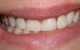 Smile following treatment to close gap between front teeth