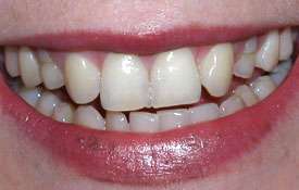 Discolored and damaged teeth
