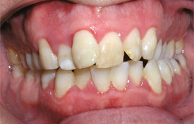 Severely yellowed teeth