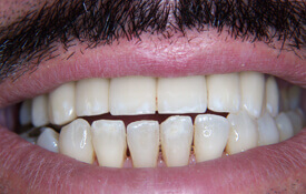 Flawlessly repaired bright white smile