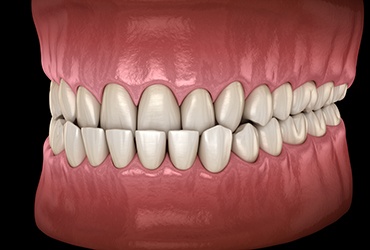 Illustration of a crowded teeth against black background